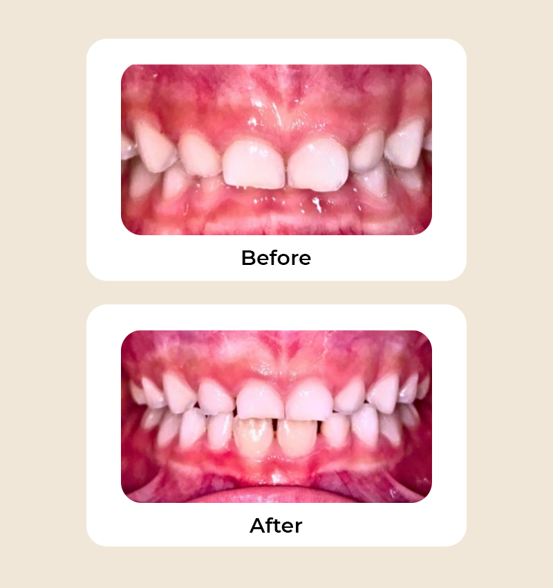 before-after-overbite