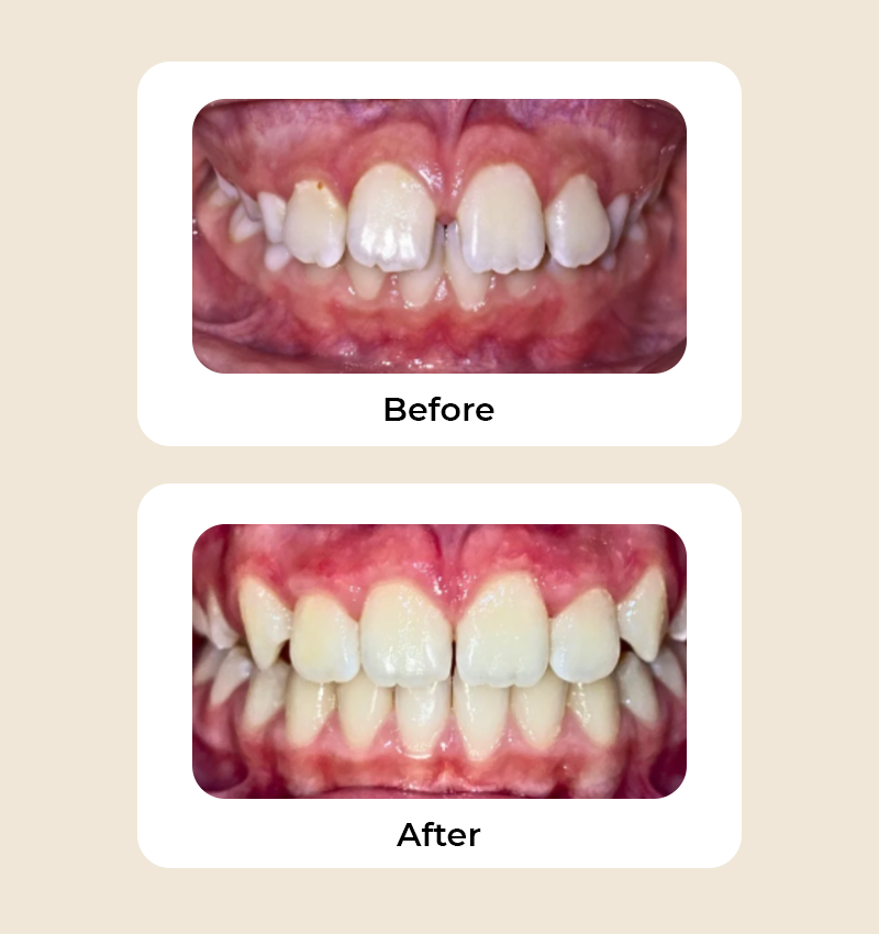 before-after-spacing