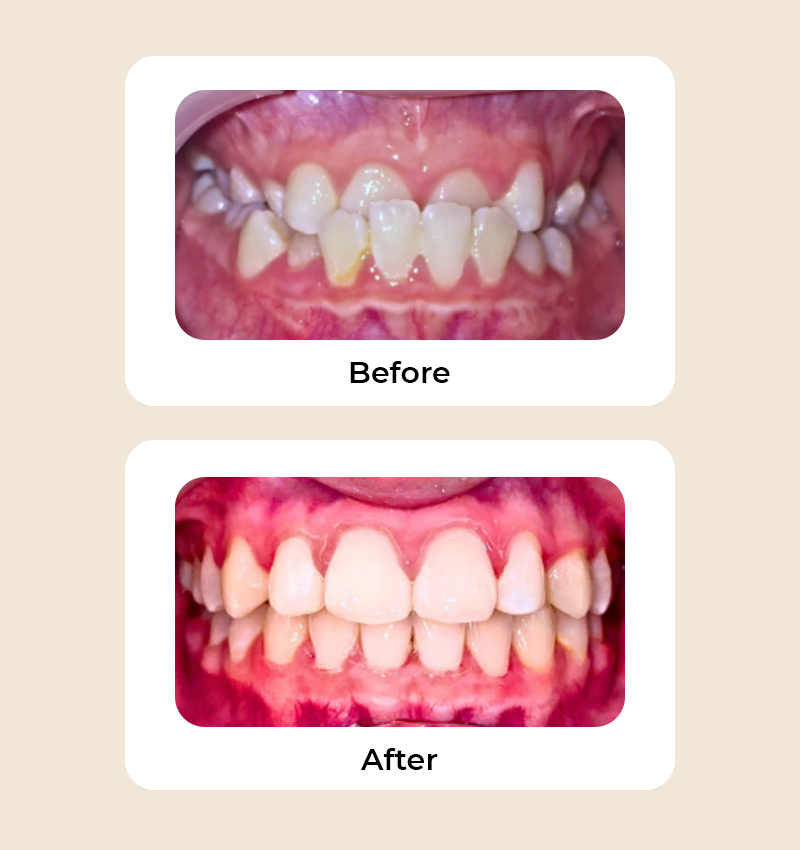 before-after-underbite