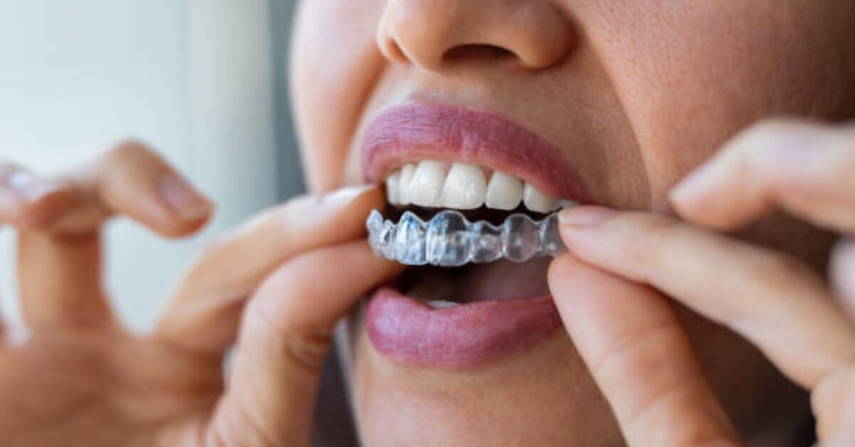 facts-about-invisalign